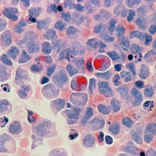 Ibrutinib with R-CHOP for untreated mantle cell lymphoma